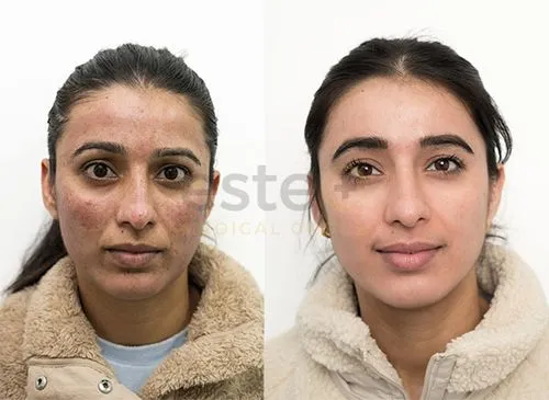 65bbacfbbf2348a1e92810c6_Mandeep-before-and-after--p-500