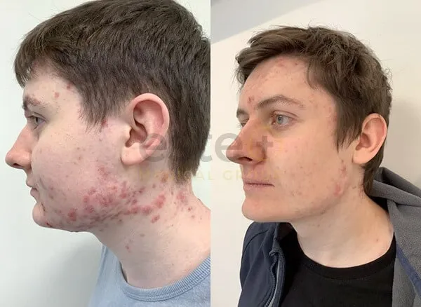 Acne Scarring Treatment