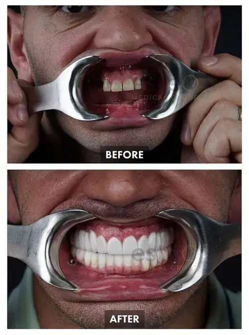 663b94c7fc827983ebdd5b38_65ba12023421a572ea90adf7_Este-Feim-Gaxha-Teeth-p-500