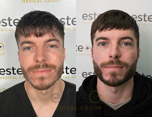 beard transplant before and after