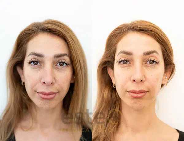 68c15dc3c0e546aa5f7b9802_Filler_-Before-after_01