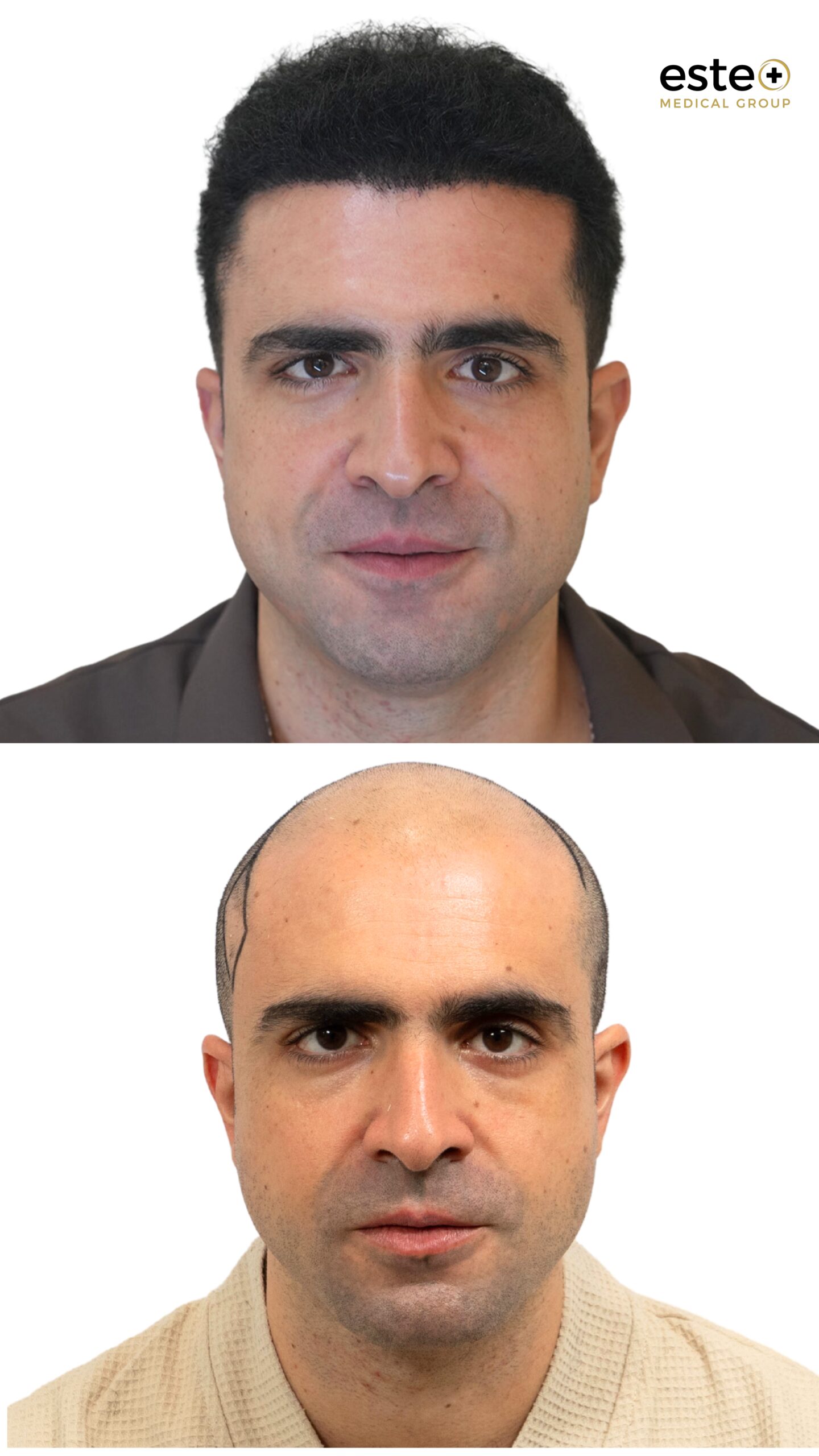Hair transplant before and after comparison