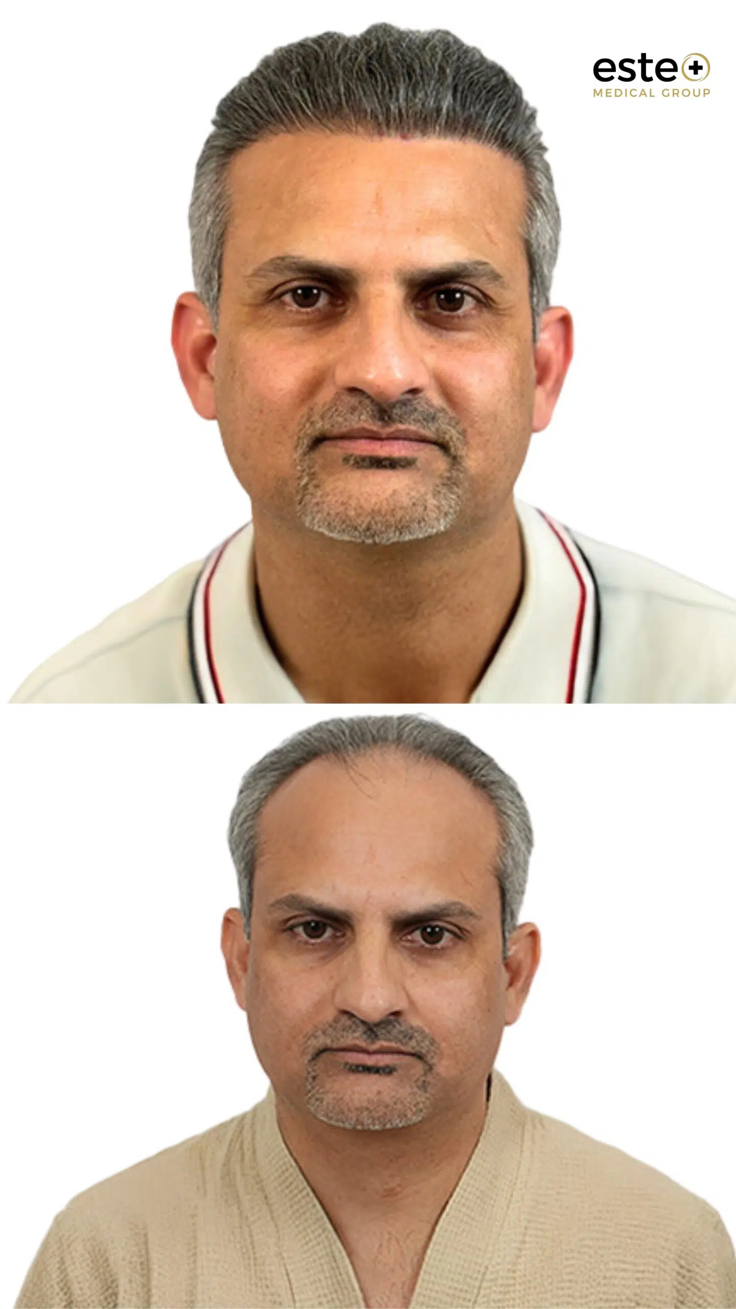 Hair transplant before and after results (UK patient)