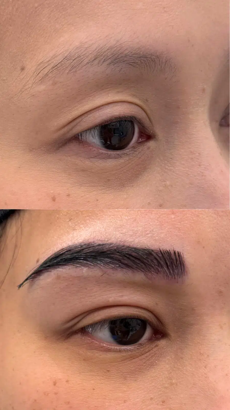 Eyebrow Hair Transplant before and after