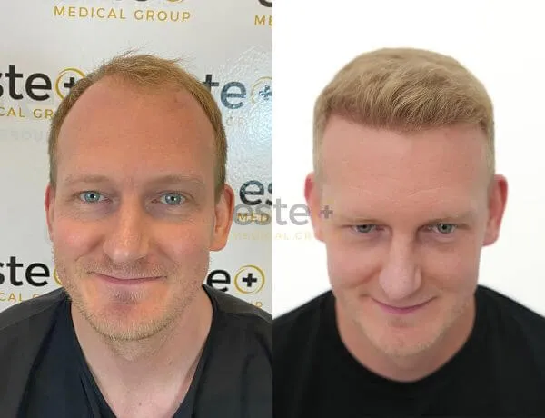 Hair Transplant before and after
