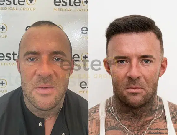 Hair Transplant before and after results