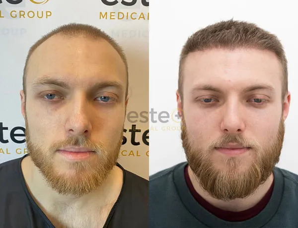 Hair Transplant before and after