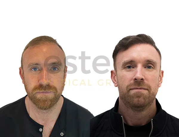 Hair Transplant before and after