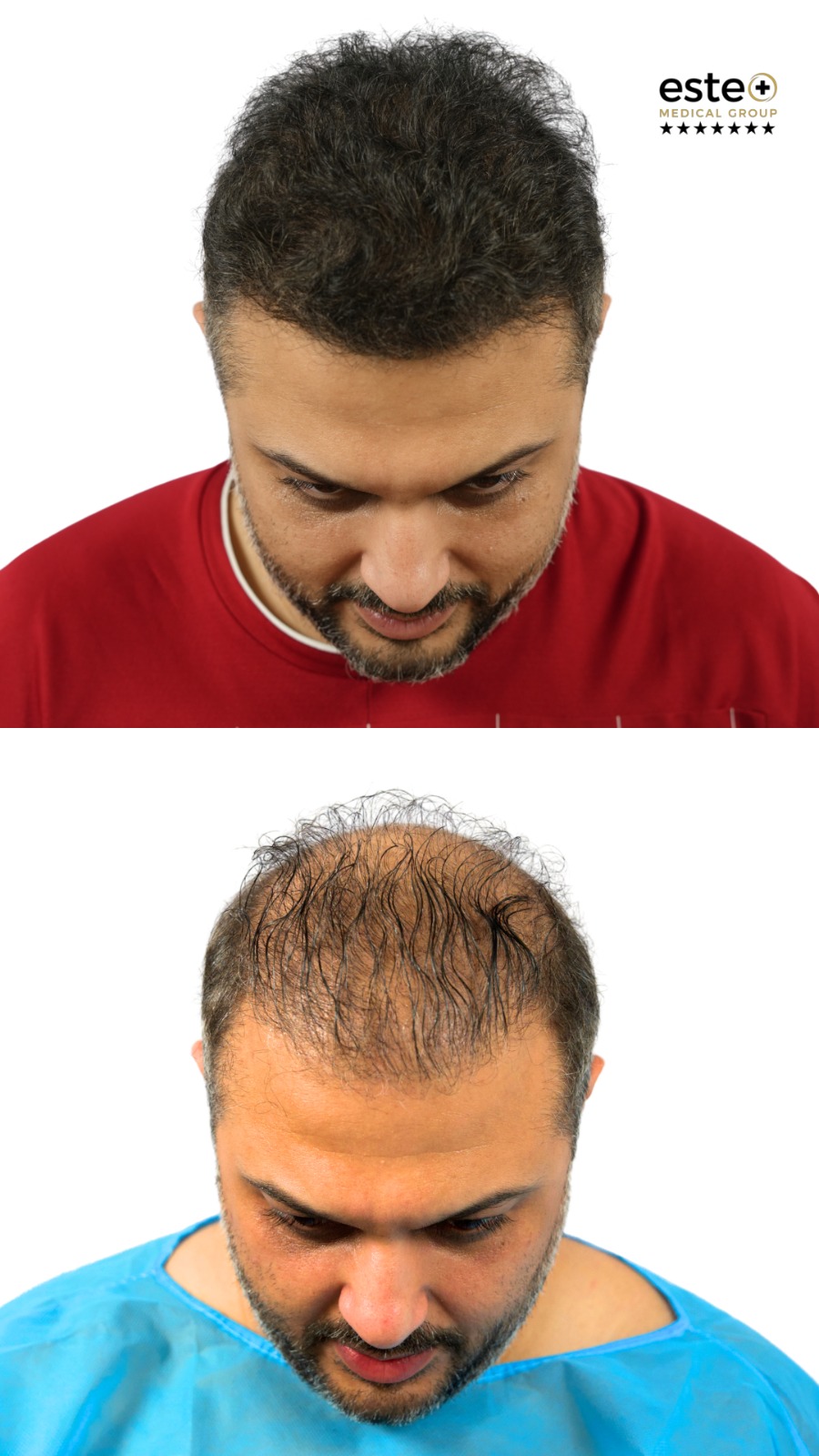 Hair transplant before and after results (visible regrowth)