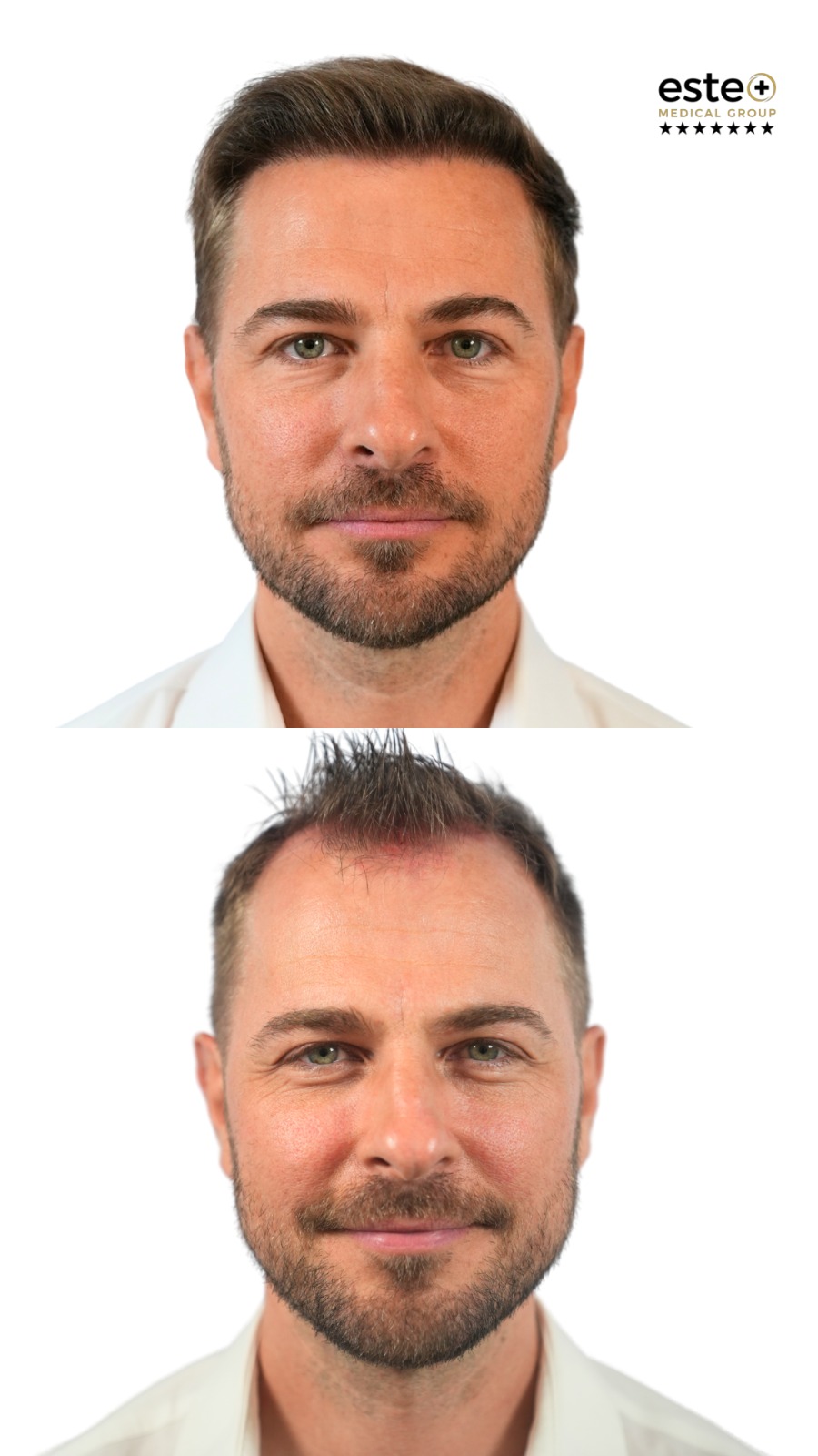 Hair transplant before and after photos (real patient results)
