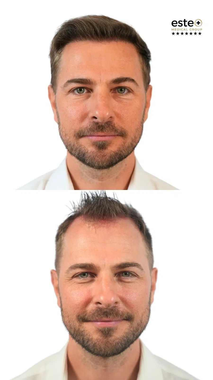 Hair transplant before and after photos (real patient results)