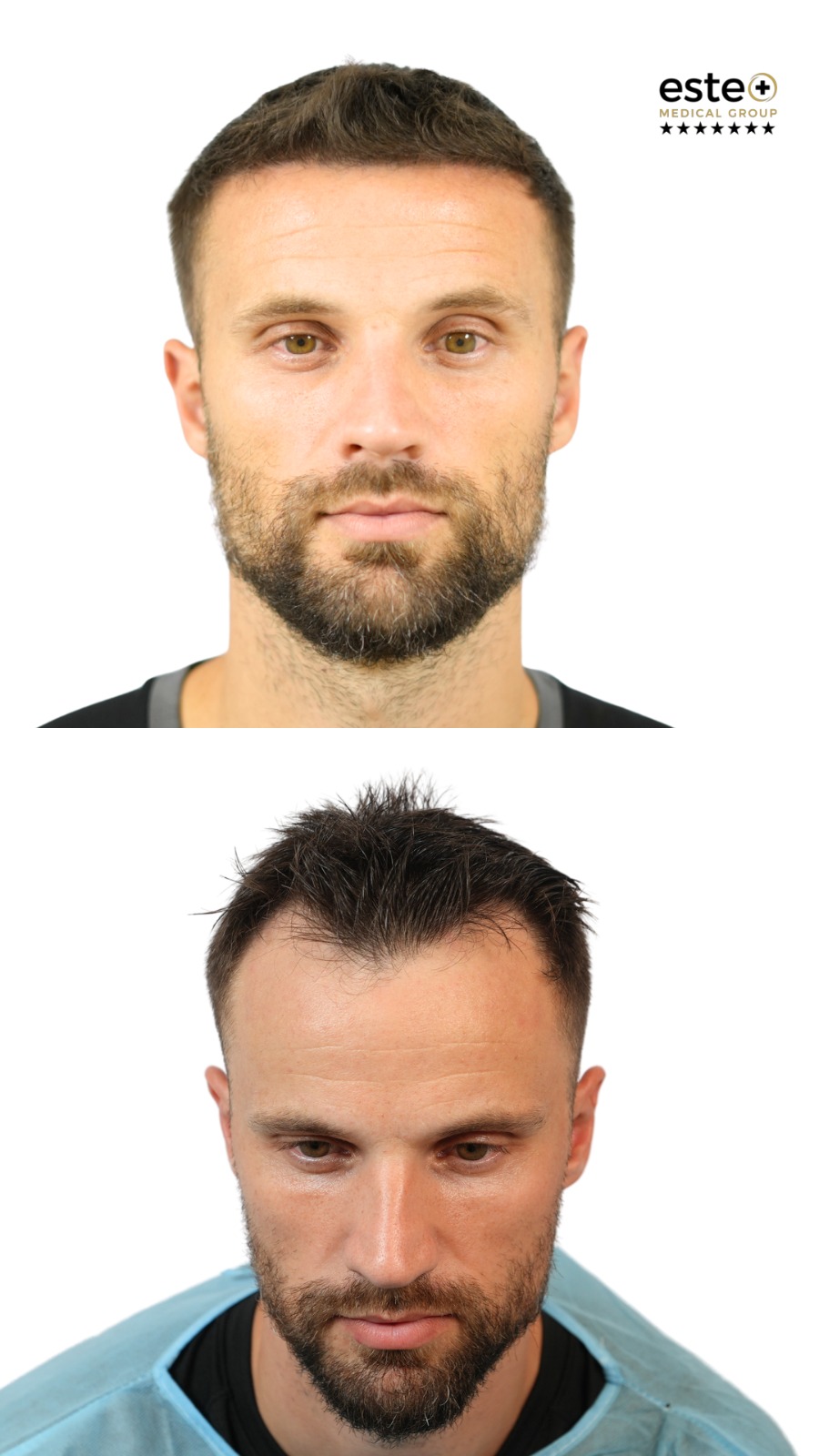 Hair transplant before and after photos (real patient results)