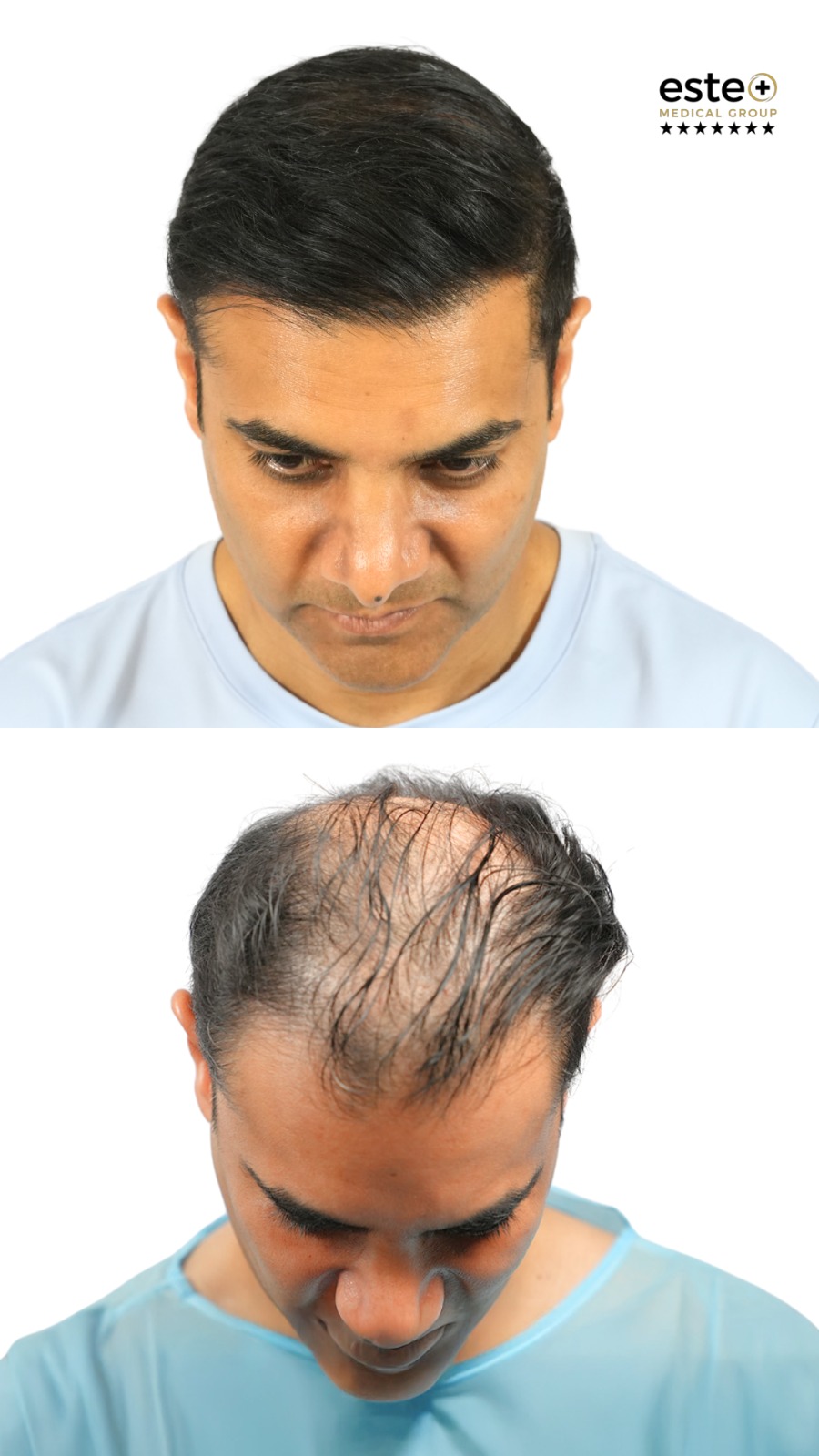 Hairline restoration before and after (hair transplant)