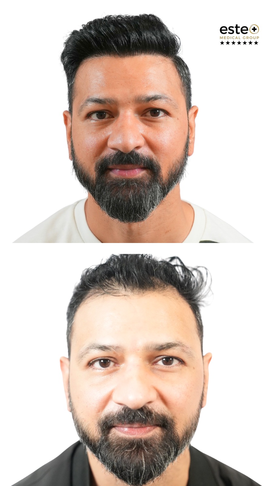 Robotic DHI hair transplant before and after results (real transformation)