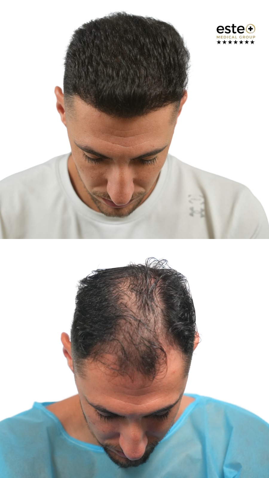 Hair transplant before and after results (patient outcome)