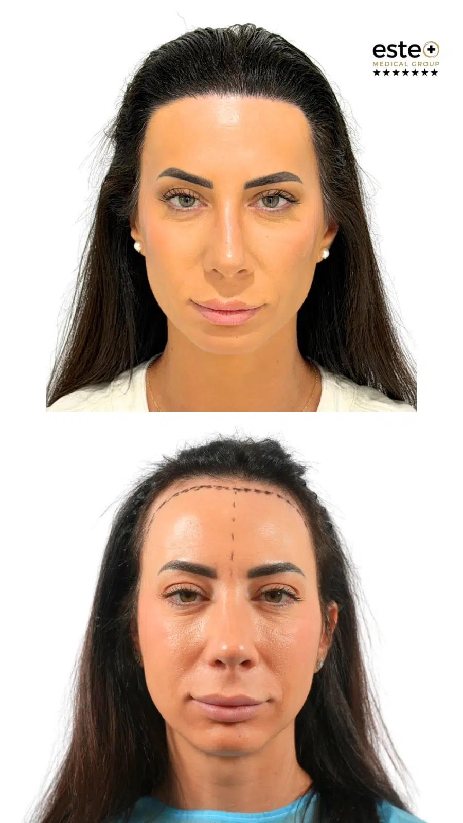 Hair transplant before and after results (natural-looking hairline)