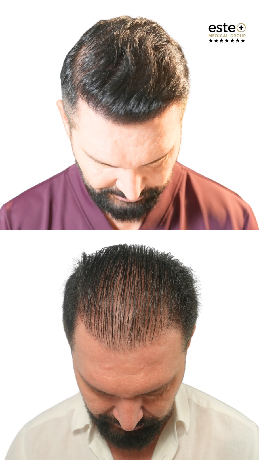Robotic DHI hair transplant before and after results