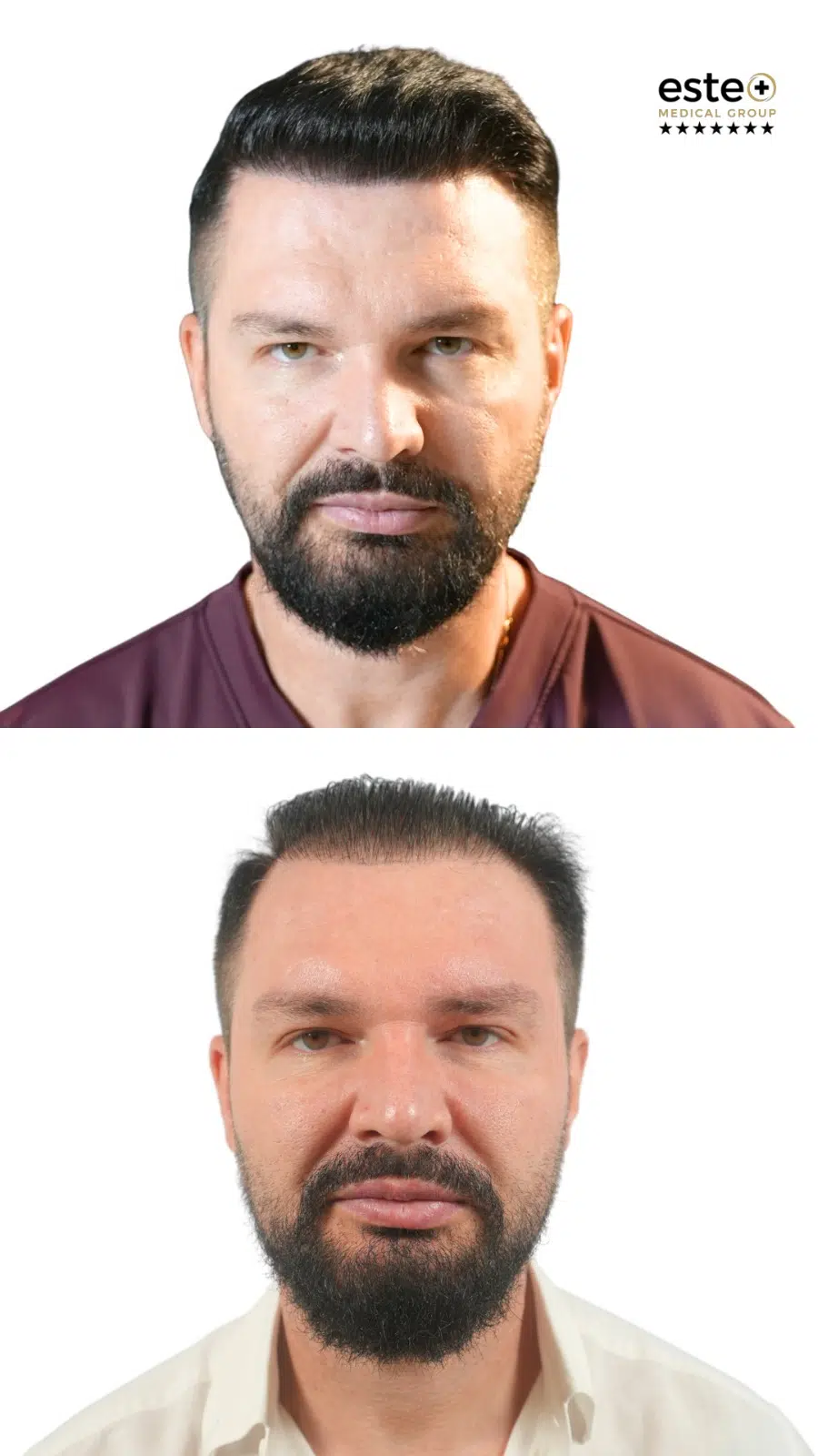 Hair transplant before and after results