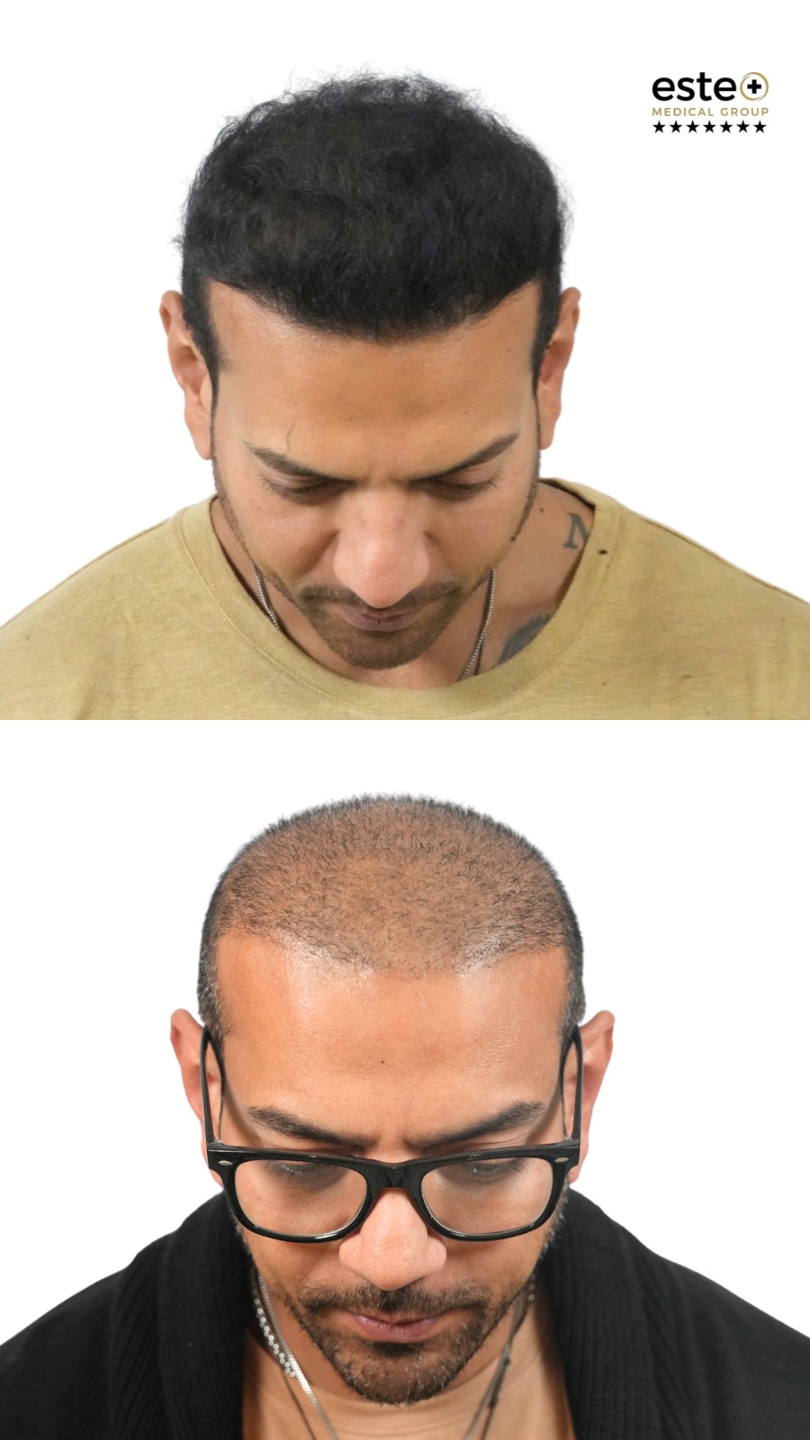 Hair transplant before and after results (natural-looking hairline)