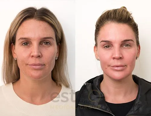 pigmentation before after