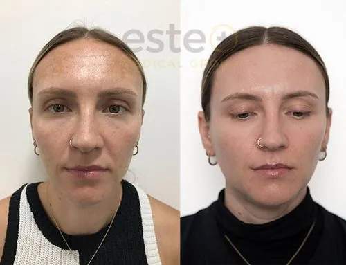 pigmentation before after