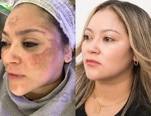 pigmentation before after