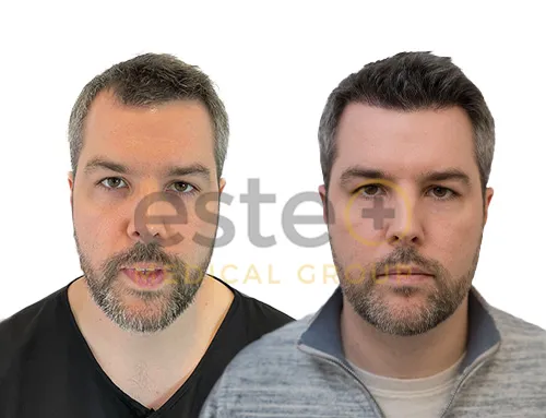 prp hair before and after