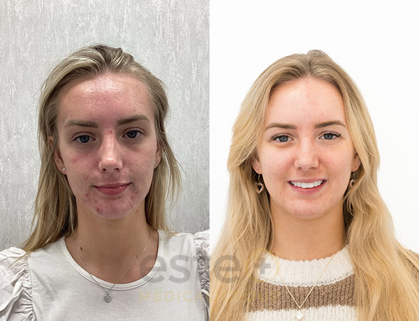 Acne results before and after treatment