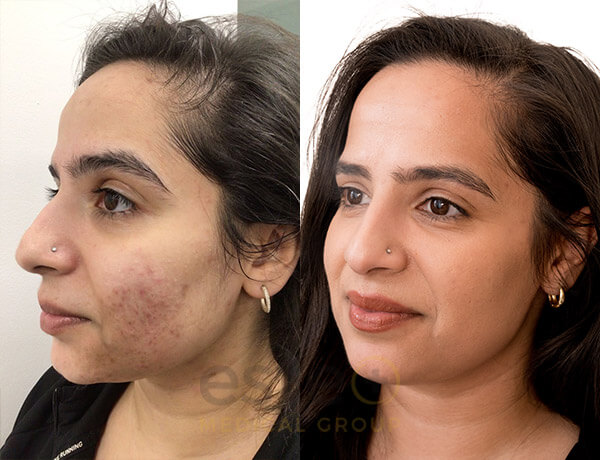 Acne recovery before and after results