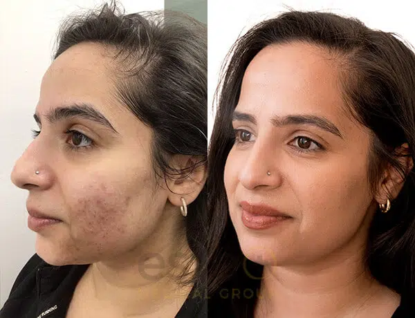 Acne recovery before and after results