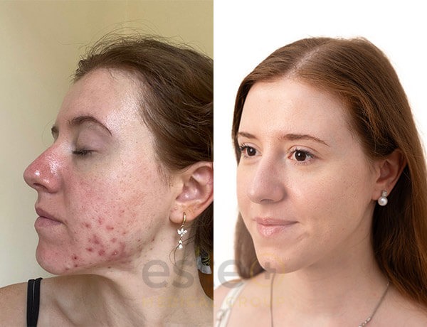 Acne marks before and after results