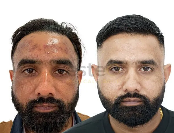 Acne before and after photos