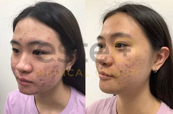 Acne before and after comparison