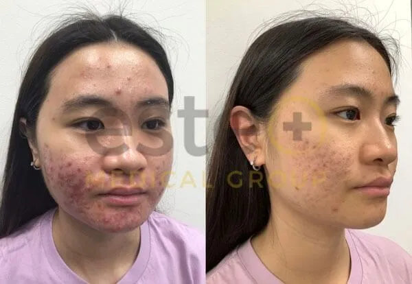 Acne treatment before and after results