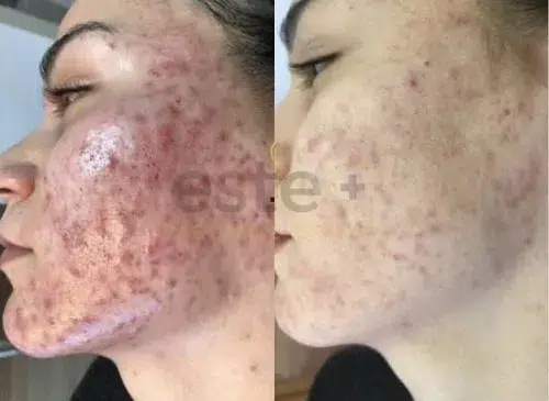 Acne improvement before and after results