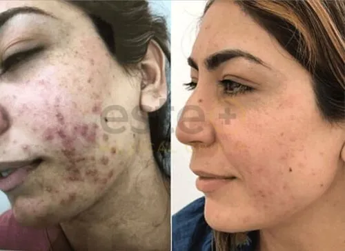 Clearer skin before and after results (acne treatment)