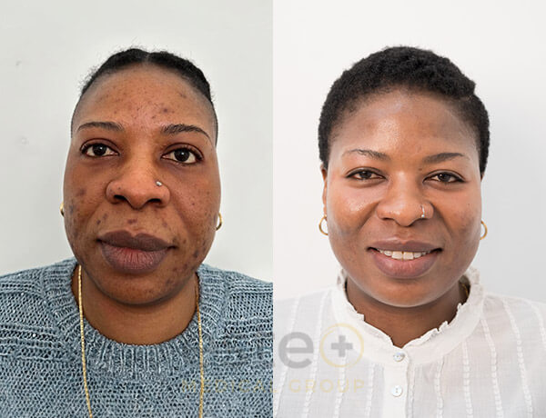 Reduced acne breakouts before and after results