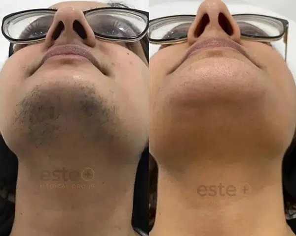 Laser Hair Removal result