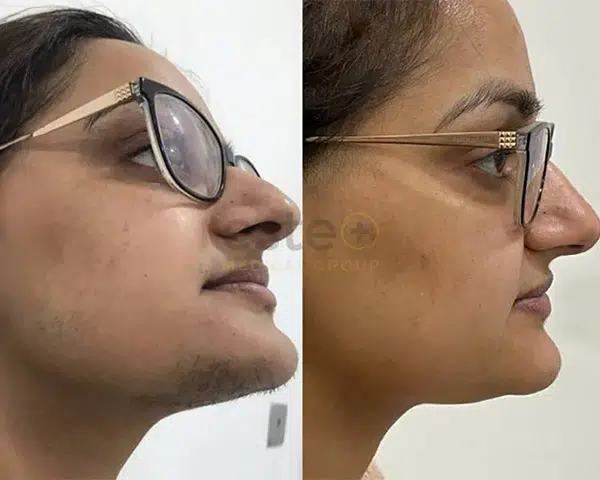 Laser Hair Removal result