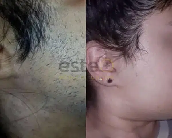 Laser Hair Removal before and after result
