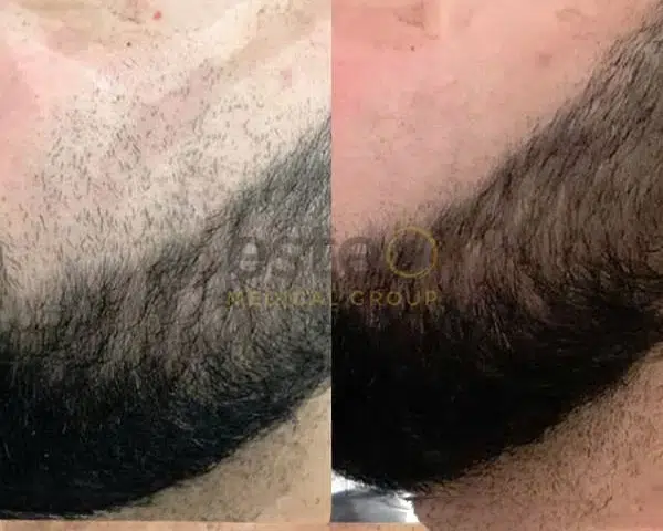 Face laser hair removal for men