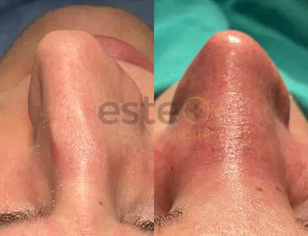 Rhinoplasty before and after results