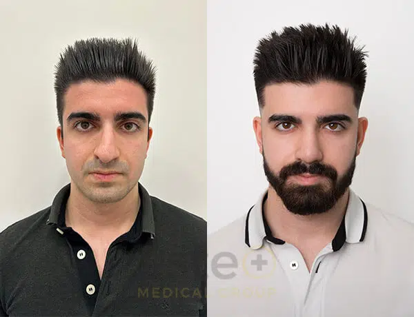 Before and after rhinoplasty results comparison