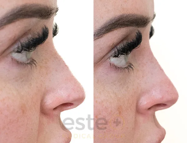 Before and after nose job results comparison