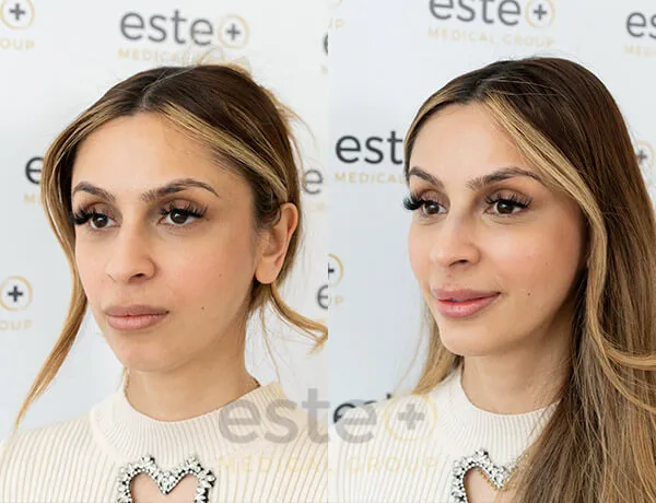 Rhinoplasty transformation before and after results