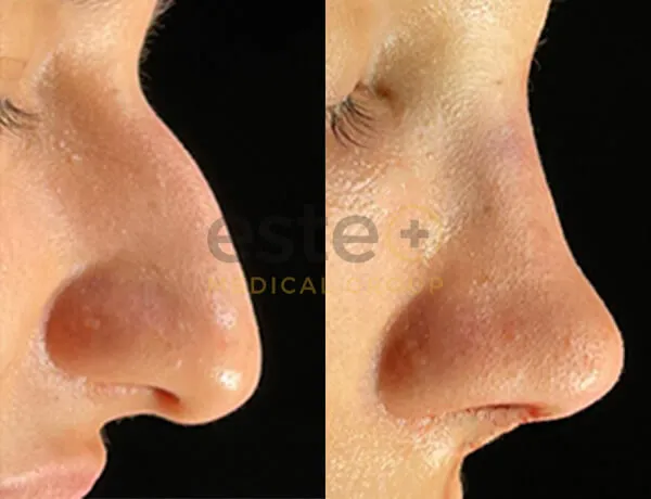 Rhinoplasty before and after photos