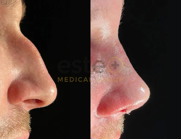 Rhinoplasty before and after comparison