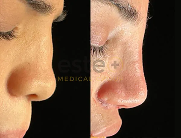 Nose job before and after results