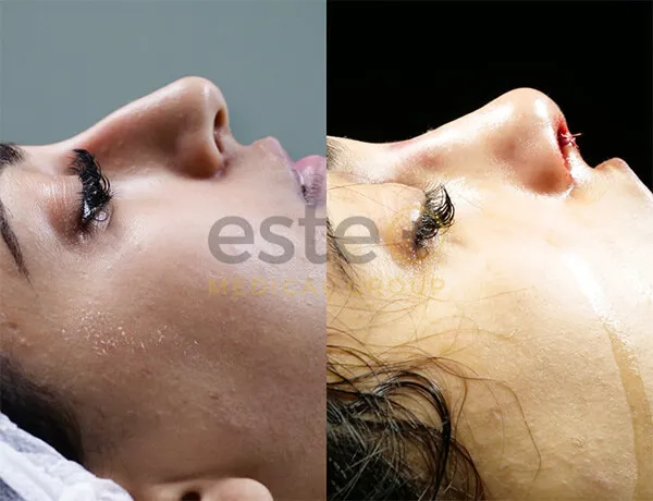 Nose job before and after photos