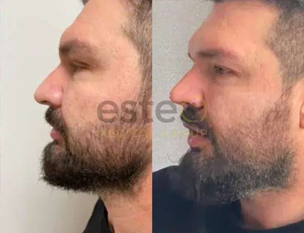 Nose shape improvement before and after results
